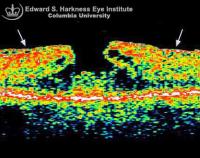 Macular pseudohole and the corresponding OCT study. Note the overlying epiretinal membrane which causes wrinkling of the overlying retina